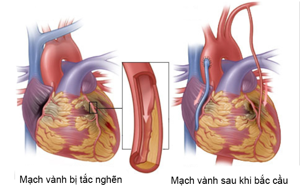 bắc cầu mạch vành.jpg